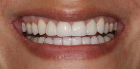 Close up of flawless teeth after full mouth reconstruction